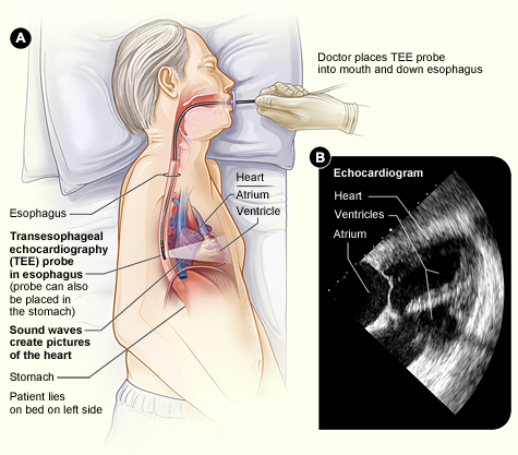 Transesophageal Echocardiography