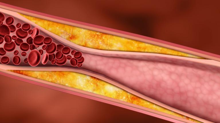 Plaque narrows blood flow in an artery.
