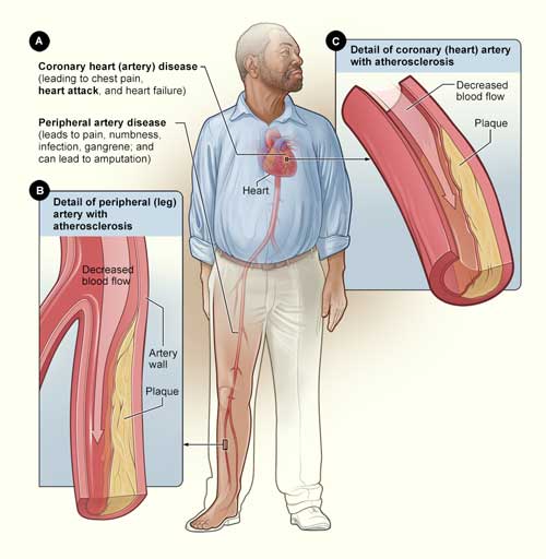 The image shows how smoking can affect arteries. Figure A shows the location of coronary heart disease and peripheral artery disease. Figure B shows a leg artery with plaque buildup partially blocking blood flow. Figure C shows a coronary (heart) artery with atherosclerosis.