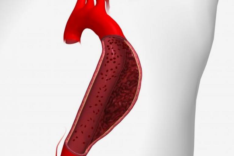 A tear in the aorta, also called an aortic dissection, is shown.