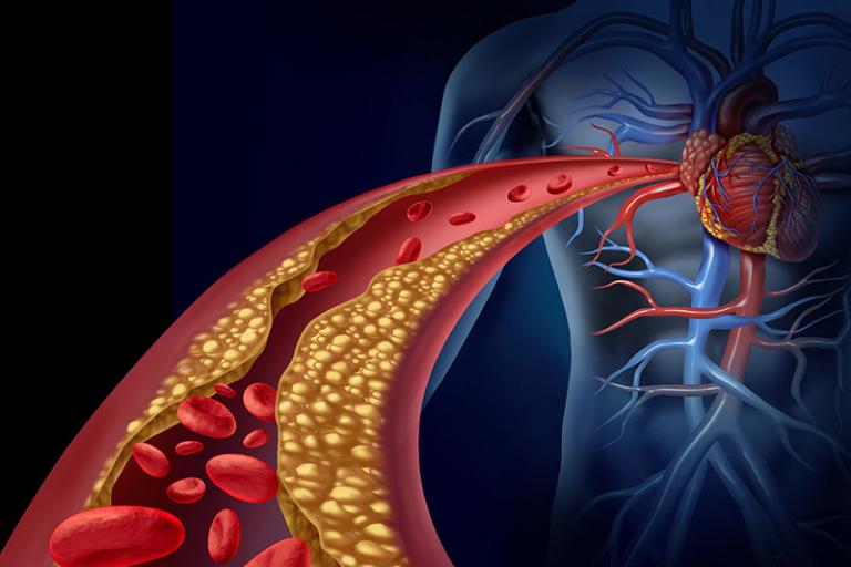  An illustration of coronary arteries that contain plaque is shown. 