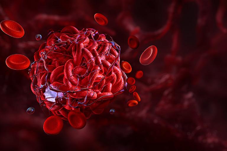 A blood clot is shown. 