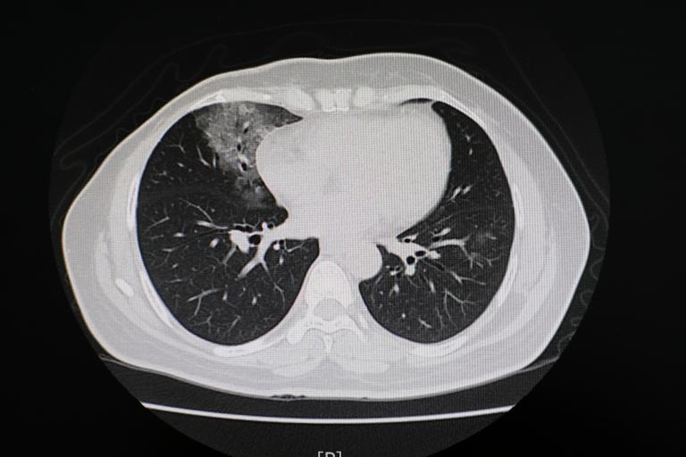 An image of a medical chest scan is shown. 