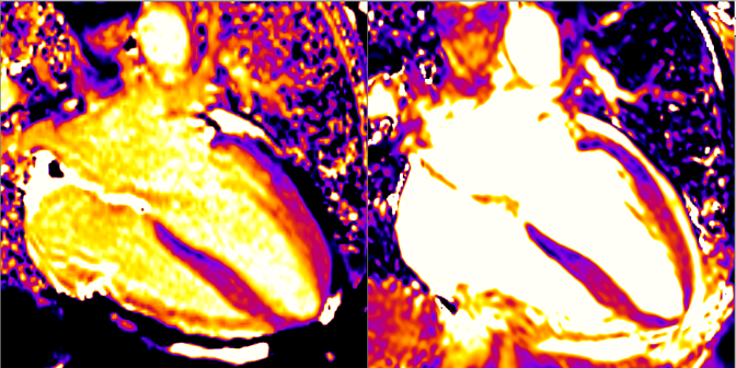 Image of heart on a cardiac MRI